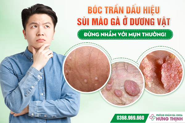 Bóc Trần Dấu Hiệu Sùi Mào Gà Ở Dương Vật: Đừng Nhầm Với Mụn Thường!