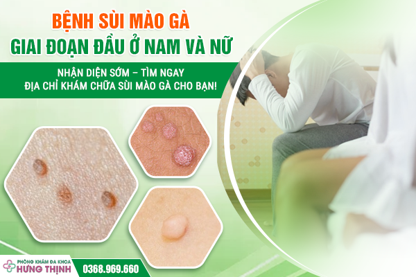 Bệnh Sùi Mào Gà Giai Đoạn Đầu Ở Nam Và Nữ: Nhận Diện Sớm – Tìm Ngay Địa Chỉ Khám Chữa Sùi Mào Gà Cho Bạn!