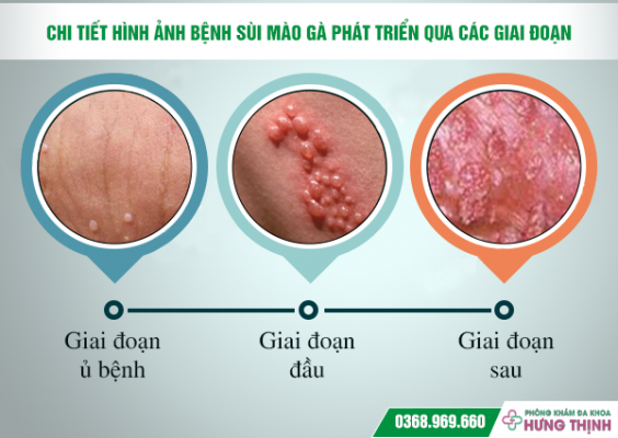 Chi Tiết Hình Ảnh Bệnh Sùi Mào Gà Phát Triển Qua Các Giai Đoạn