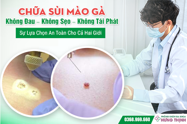 Chữa Sùi Mào Gà Không Đau – Không Sẹo – Không Tái Phát: Sự Lựa Chọn An Toàn Cho Cả Hai Giới