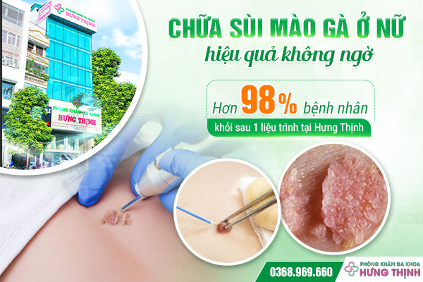 Chữa sùi mào gà ở nữ hiệu quả không ngờ. Hơn 98% bệnh nhân khỏi sau 1 liệu trình tại Hưng Thịnh