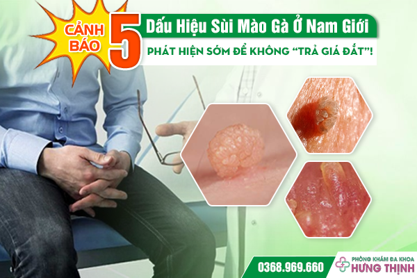 [CẢNH BÁO] 5 Dấu Hiệu Sùi Mào Gà Ở Nam Giới – Phát Hiện Sớm Để Không “Trả Giá Đắt”!