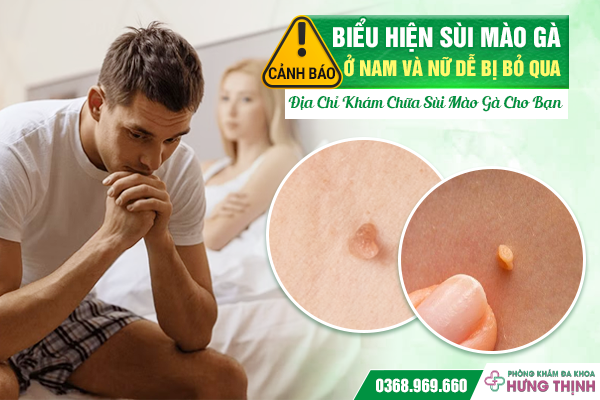 Cảnh Báo: Biểu Hiện Sùi Mào Gà Ở Nam Và Nữ Dễ Bị Bỏ Qua – Địa Chỉ Khám Chữa Sùi Mào Gà Cho Bạn
