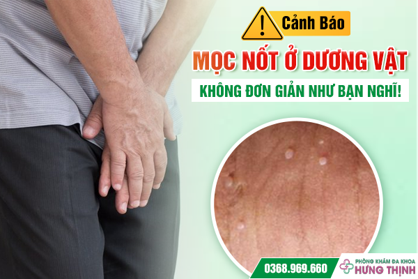 Cảnh Báo: Mọc Nốt Ở Dương Vật Không Đơn Giản Như Bạn Nghĩ!