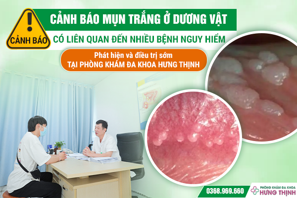 Cảnh báo mụn trắng ở dương vật có liên quan đến nhiều bệnh nguy hiểm. Phát hiện và điều trị sớm tại phòng khám Đa khoa Hưng Thịnh kẻo chậm trễ.