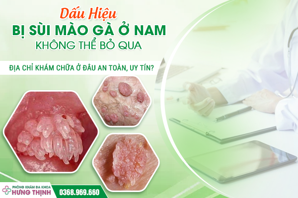 Dấu Hiệu Bị Sùi Mào Gà Ở Nam Không Thể Bỏ Qua – Địa Chỉ Khám Chữa Ở Đâu An Toàn, Uy Tín?