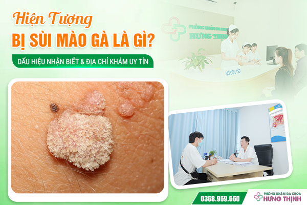 Hiện Tượng Bị Sùi Mào Gà Là Gì? Dấu Hiệu Nhận Biết & Địa Chỉ Khám Uy Tín