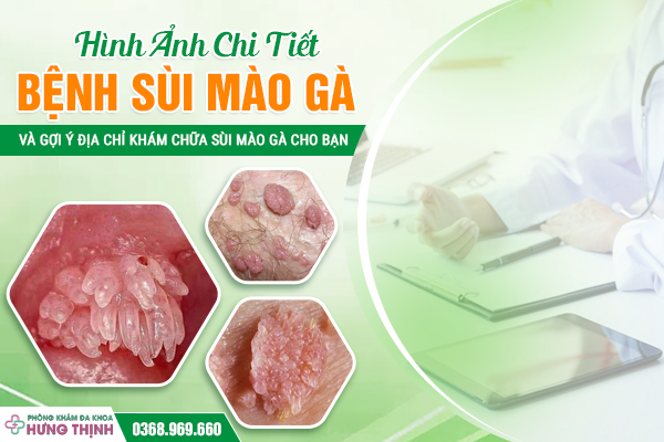 Hình Ảnh Chi Tiết Bệnh Sùi Mào Gà Và Gợi Ý Địa Chỉ Khám Chữa Sùi Mào Gà Cho Bạn