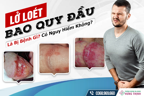 Viêm loét bao quy đầu là gì? địa chỉ chữa Viêm loét bao quy đầu uy tín nhất Hà Nội