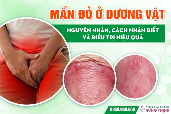 Mẩn Đỏ Ở Dương Vật: Nguyên Nhân, Cách Nhận Biết và Điều Trị Hiệu Quả