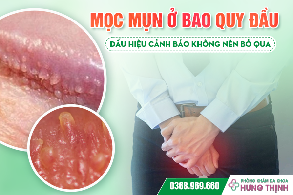 Mọc Mụn Ở Bao Quy Đầu: Dấu Hiệu Cảnh Báo Không Nên Bỏ Qua