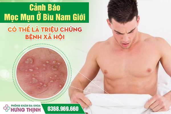 Cảnh Báo: Mọc Mụn Ở Bìu Nam Giới Có Thể Là Triệu Chứng Bệnh Xã Hội