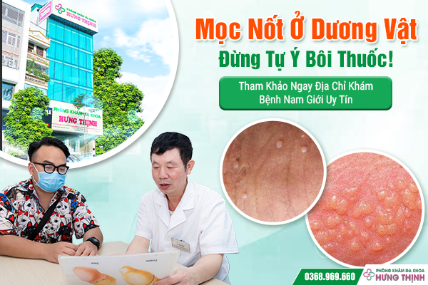 Mọc Nốt Ở Dương Vật: Đừng Tự Ý Bôi Thuốc! Tham Khảo Ngay Địa Chỉ Khám Bệnh Nam Giới Uy Tín
