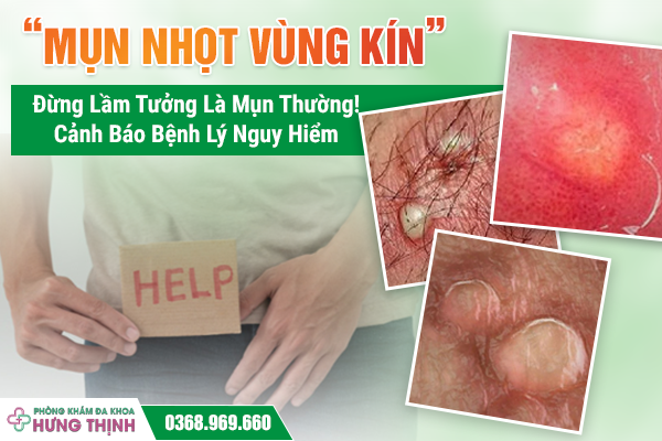 “Mụn Nhọt Vùng Kín” – Đừng Lầm Tưởng Là Mụn Thường! Cảnh Báo Bệnh Lý Nguy Hiểm