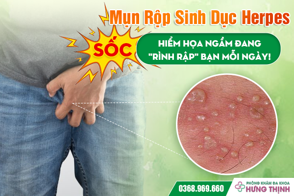 [SỐC] Mụn Rộp Sinh Dục Herpes: Hiểm Họa Ngầm Đang 