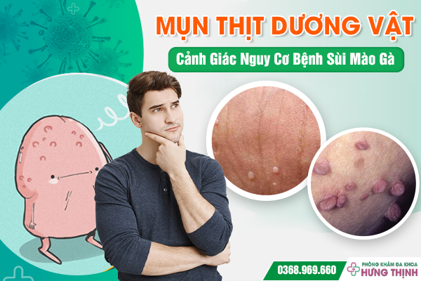 Mụn Thịt Dương Vật: Cảnh Giác Nguy Cơ Bệnh Sùi Mào Gà 