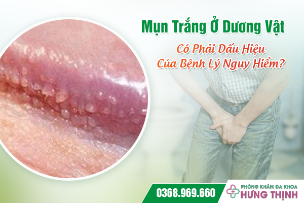 Mụn Trắng Ở Dương Vật Có Phải Dấu Hiệu Của Bệnh Lý Nguy Hiểm?
