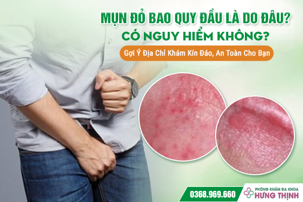 Mụn Đỏ Bao Quy Đầu Là Do Đâu? Có Nguy Hiểm Không? Gợi Ý Địa Chỉ Khám Kín Đáo, An Toàn Cho Bạn