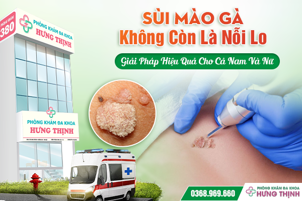 Sùi Mào Gà Không Còn Là Nỗi Lo – Giải Pháp Hiệu Quả Cho Cả Nam Và Nữ