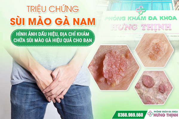Triệu Chứng Sùi Mào Gà Nam: Hình Ảnh Dấu Hiệu, Địa Chỉ Khám Chữa Sùi Mào Gà Hiệu Quả Cho Bạn
