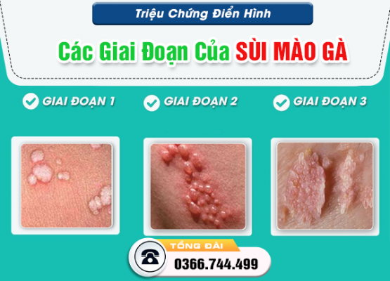 [Tìm Hiểu] Triệu Chứng Điển Hình Các Giai Đoạn Của Sùi Mào Gà