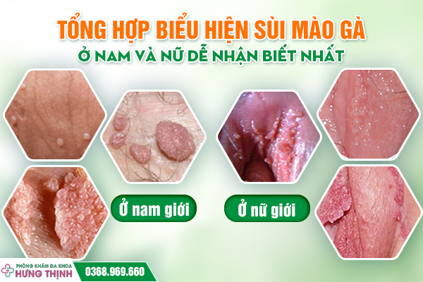 Tổng Hợp Biểu Hiện Sùi Mào Gà Ở Nam Và Nữ Dễ Nhận Biết Nhất