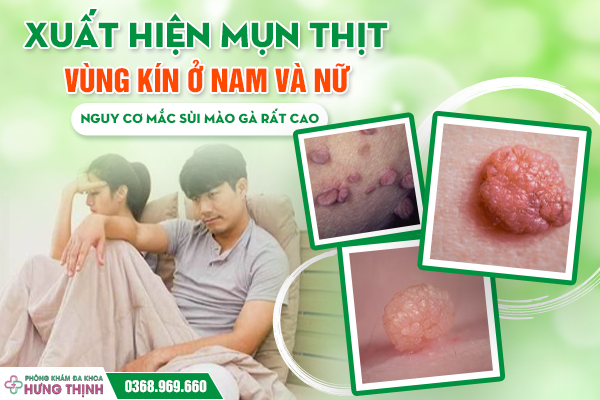 Xuất Hiện Mụn Thịt Vùng Kín Ở Nam Và Nữ: Nguy Cơ Mắc Sùi Mào Gà Rất Cao