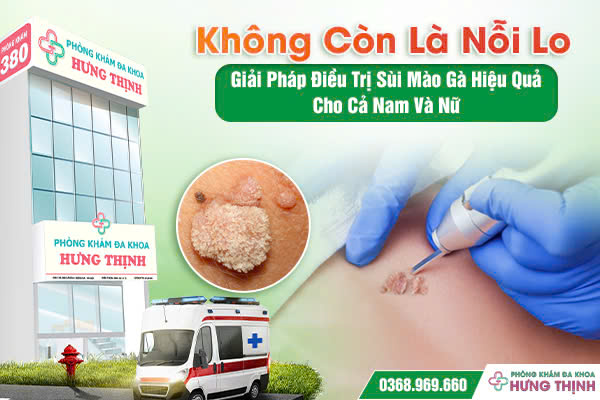 Không Còn Là Nỗi Lo – Giải Pháp Điều Trị Sùi Mào Gà Hiệu Quả Cho Cả Nam Và Nữ