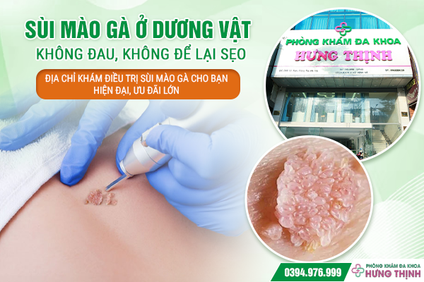 Điều Trị Sùi Mào Gà Không Đau, Không Để Lại Sẹo – Địa Chỉ Khám Điều Trị Sùi Mào Gà Cho Bạn Hiện Đại, Ưu Đãi Lớn