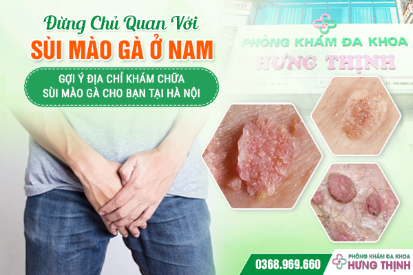 Đừng Chủ Quan Với Sùi Mào Gà Ở Nam – Gợi Ý Địa Chỉ Khám Chữa Sùi Mào Gà Cho Bạn Tại Hà Nội